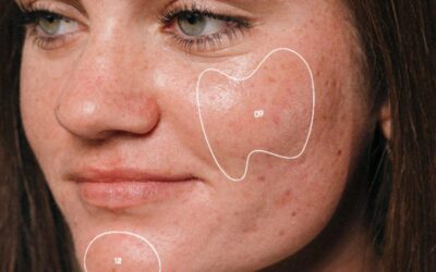 Acne: Types, Causes, Treatment And Prevention